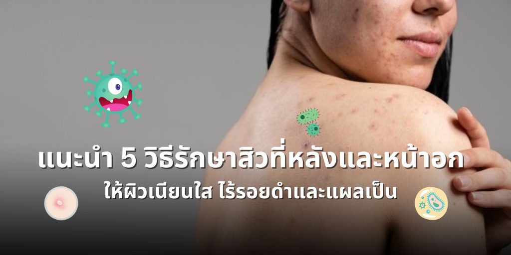 แนะนำ 5 วิธีรักษาสิวที่หลังและหน้าอก